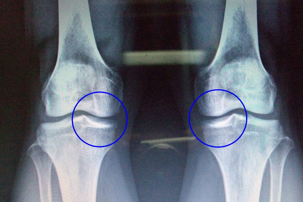 03 你的膝盖健康吗, 实际膝部x光片及可能问题点